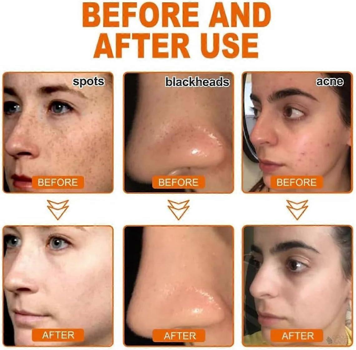 LOVILDS™ Whitening and Freckle - Removing Mask 🔥Last Day Promotion 49% OFF🔥